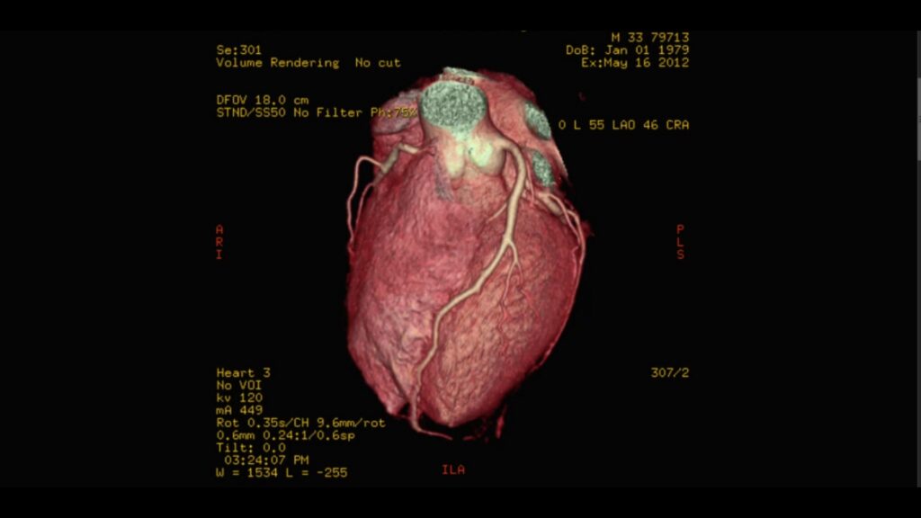 CT Angiography