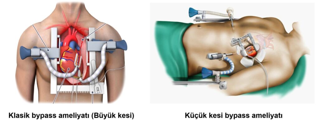 Bypass Surgery 4 Bypass Surgery