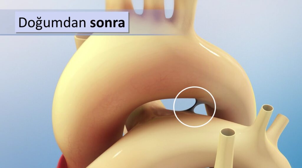 PDA Closure