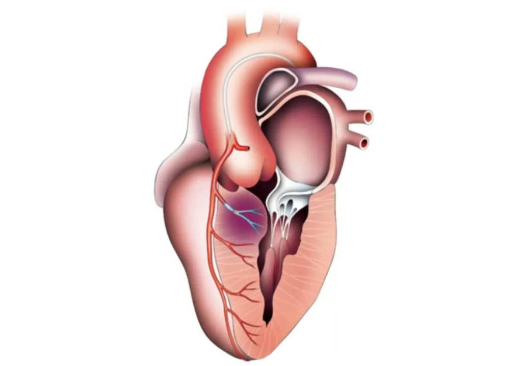 Alkol Septal Ablasyon