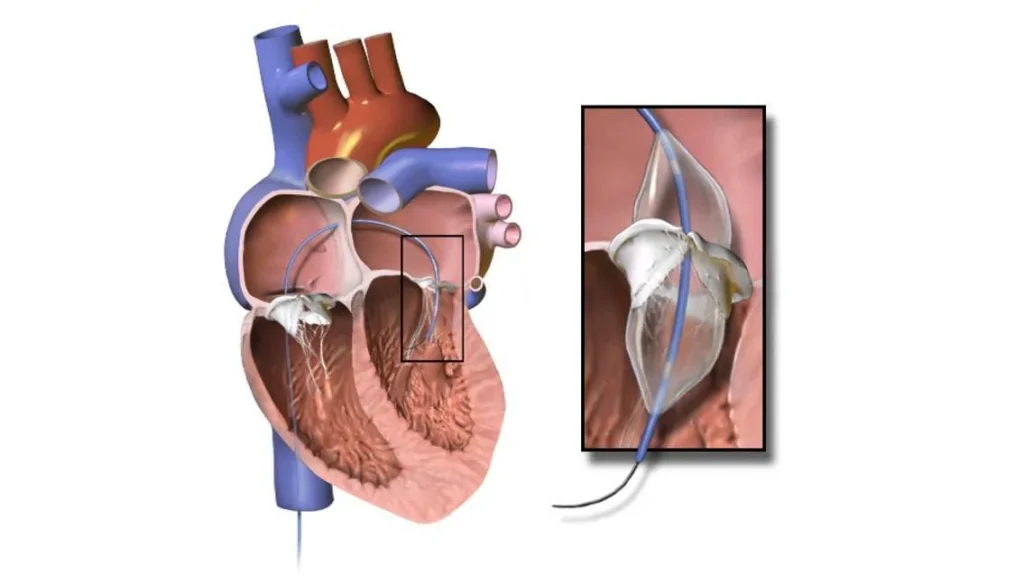 Mitral Balon