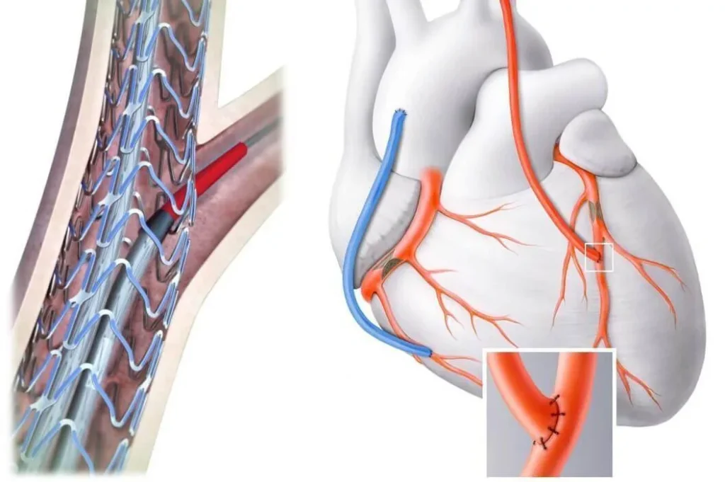 Stent mi, Bypass mı?