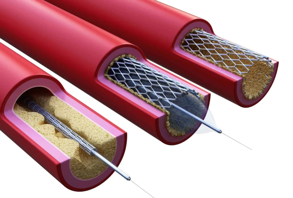 Stent