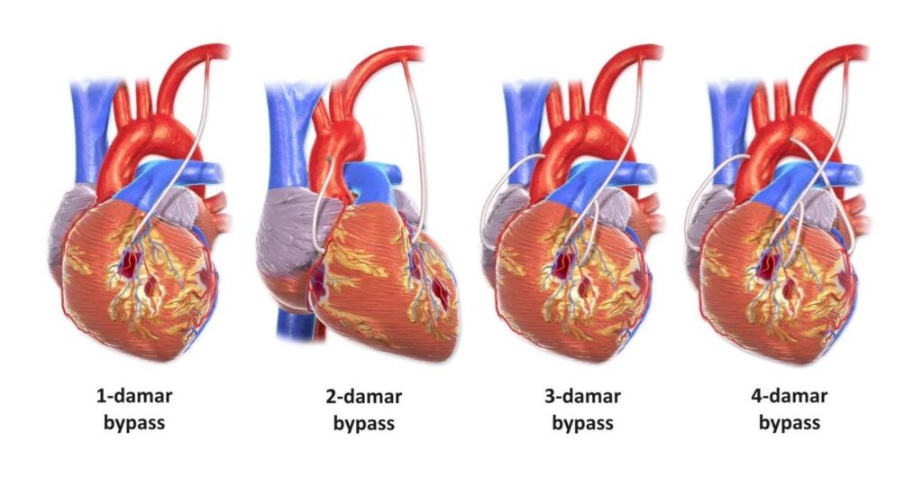 Bypass Surgery