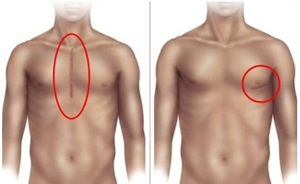 Bypass Surgery 5 Bypass Surgery